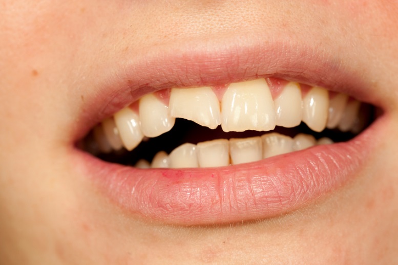 Broken teeth how dental assistant students should treat it 